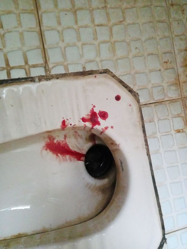 早上上厕所上大的突然很多血吓死我了