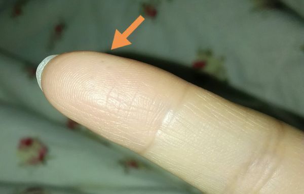 我的右手食指指腹长了3颗红点,有点小凸起,但是感觉是长在皮肤里面的