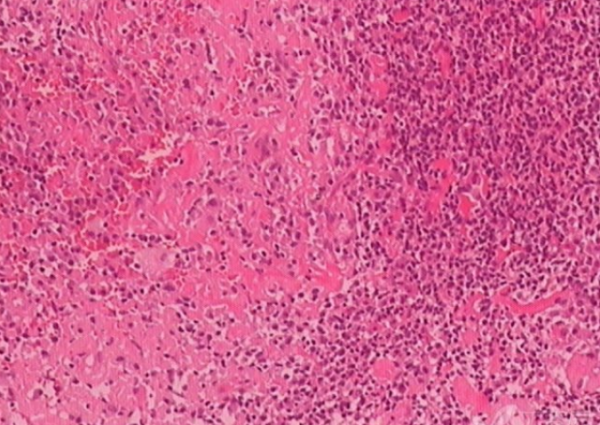 骨髓刚果红染色图片