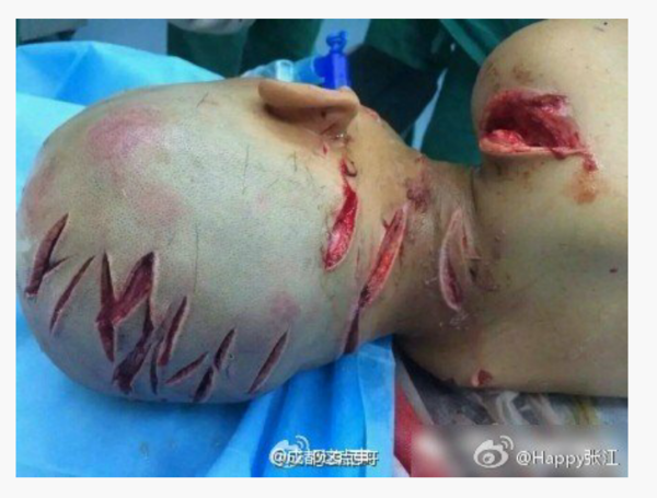 心痛,五岁男童被继母连砍三十多刀,锁骨被斩断