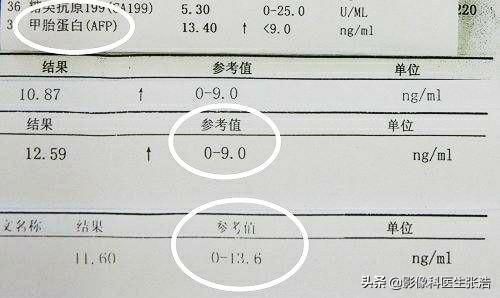 癌胚抗原多少才算癌症