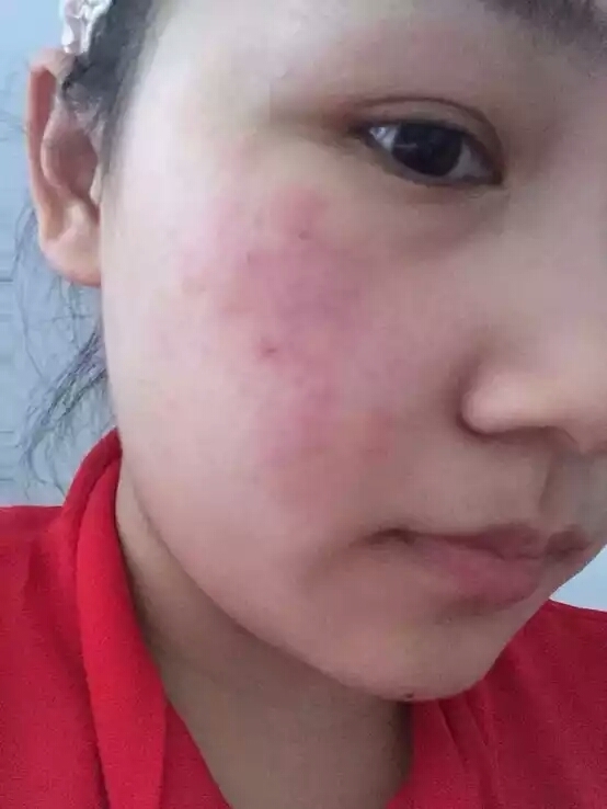 过敏性皮肤怎么修复