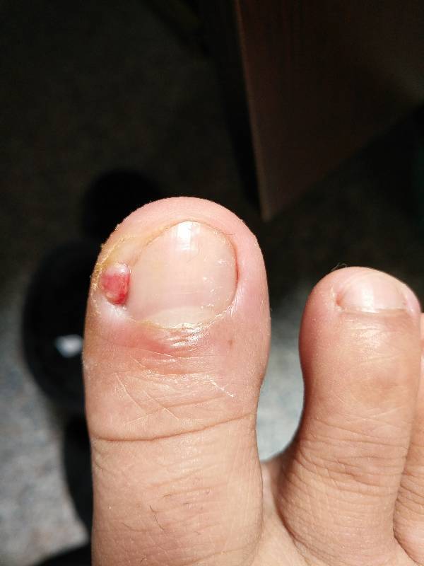 甲沟炎,有图,急!昨天去医院,医生给配了药膏,说是初期,用药