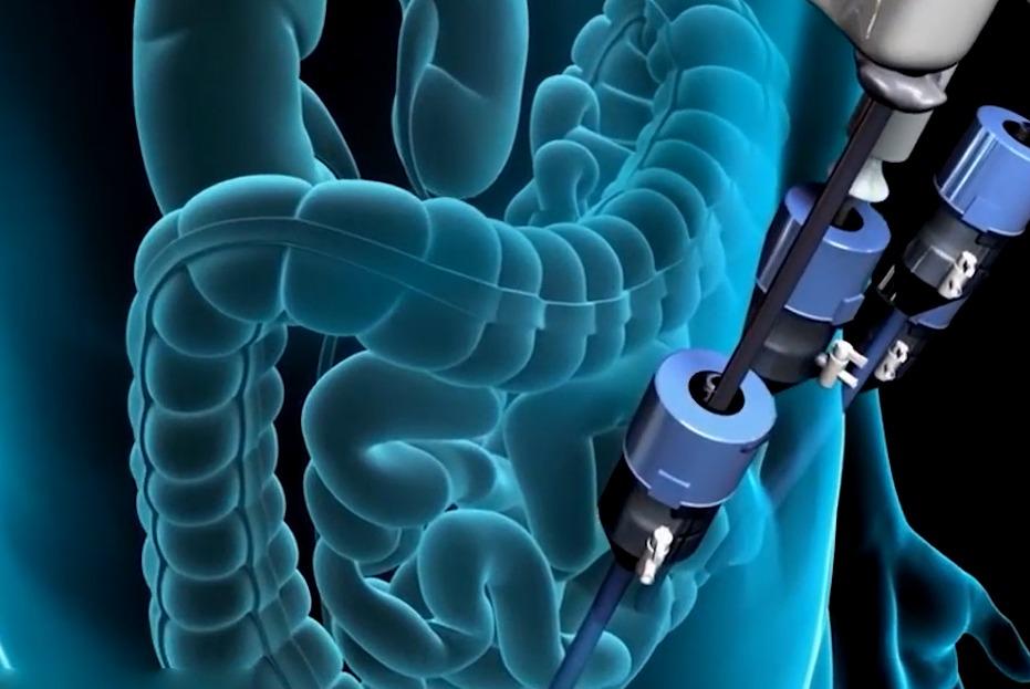 视频:3d动画科普演示 前列腺切除手术全过程,看的人都感觉到疼