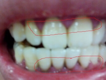 牙齿根部发黑怎么去除图片