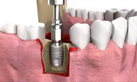 请问iti种植体是什么?