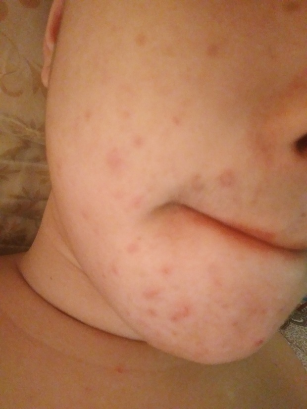 以前不洗脸都不长痘,现在洗脸反而长了很多很