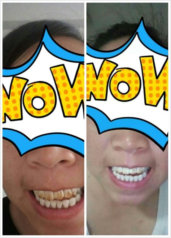 艾丝拉美牙仪效果怎么样,多少钱一盒