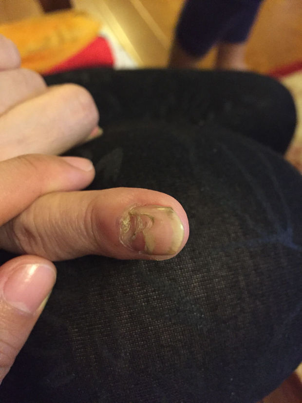 妈妈50岁这一月内左手食指指甲从内向外烂