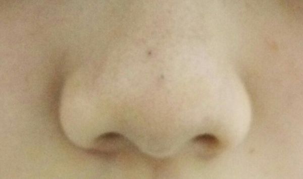 鼻子上有两个好大黑头洞,怎么办,好明显。急,打