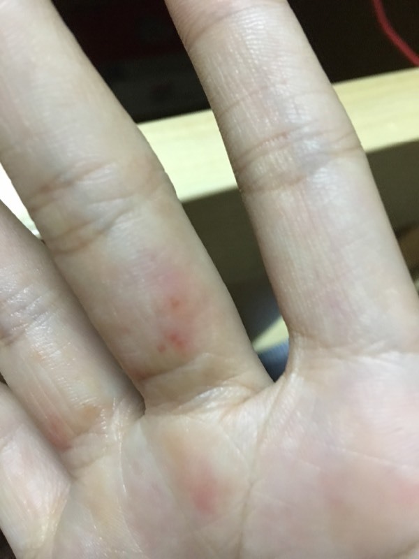 手指关节末端一直长这些红红的疙瘩,很痒,一碰就痒.很久才好,好了