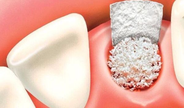 种植牙后骨粉有什么作用?要多长时间才能吸收