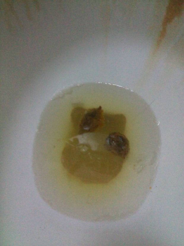 便意频繁,食欲低下,乏力腹部隐隐作痛,恶心,大便