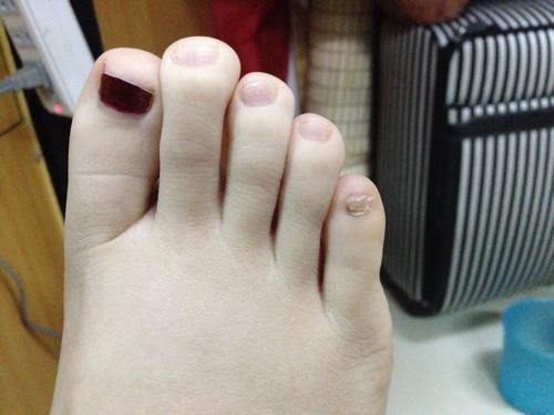 指甲边缘逐渐变黑