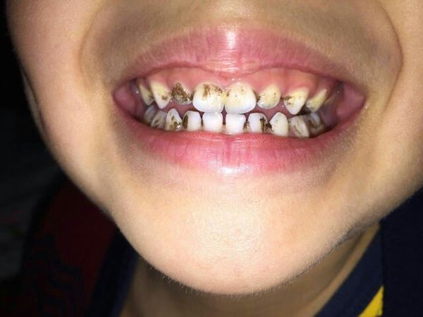 小孩的牙齿黑黑的是什么有没什么办法去掉