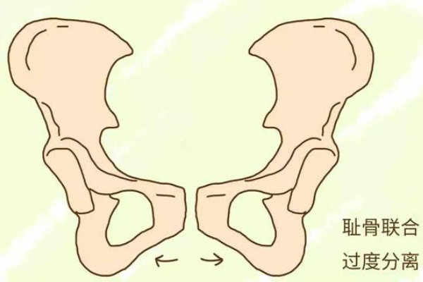 稱恥骨梳,向後移行於弓狀線,向前終於恥骨結節,是重要體表標