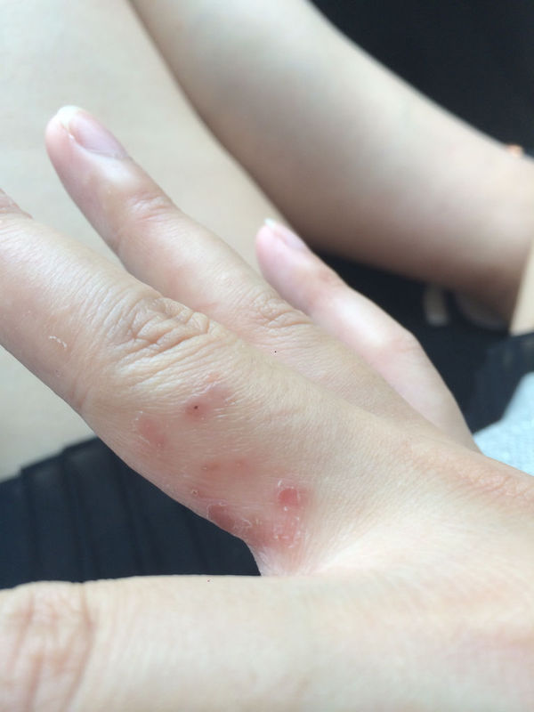 手上的小水泡很痒,起皮,冬天指腹上也会长很多长了以后手指会起皮撕裂