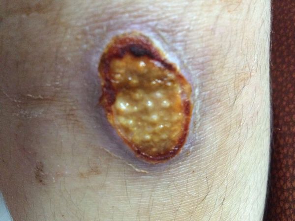 脚上摔了有伤口,一直流脓,2周了都没好,伤口上