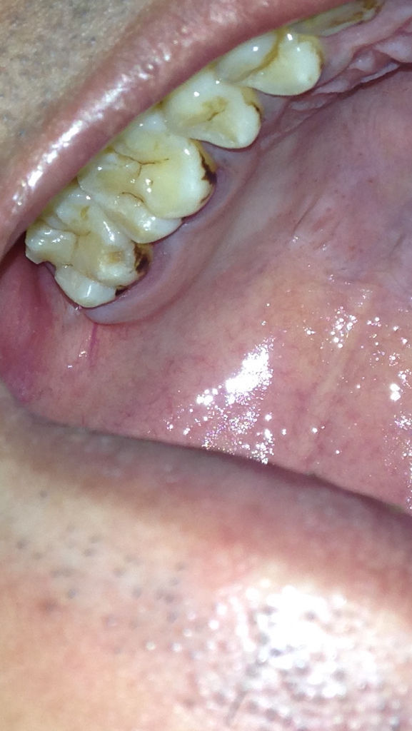 这牙齿缺了一块,是蛀牙吗?被牙虫吃掉的吗?这