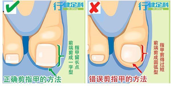 甲沟炎已化脓出血,做拔甲手术会不会再复