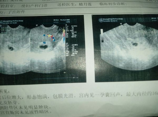 怀孕5周如何看b超单判断是不是双胞胎?b超单