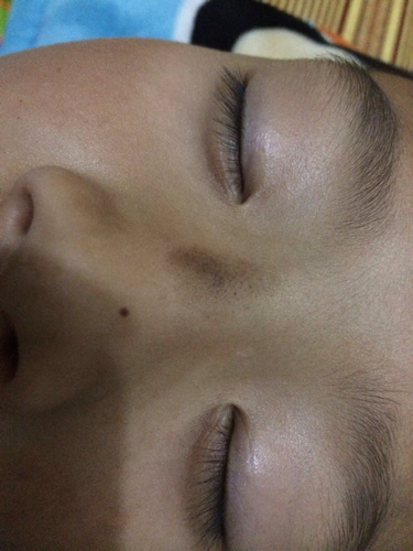 小朋友 消除胎记,黑色素毛表皮痣.小朋友今年7周岁,出生时有明显胎记.