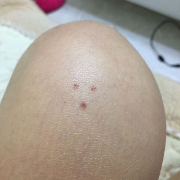 今天发现膝盖上起来三个小红点,不疼不痒,而且