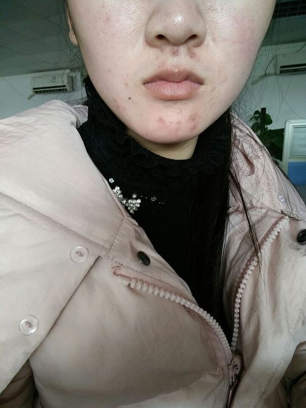 一到冬天就容易长痘 下巴和嘴角两旁 什么原因