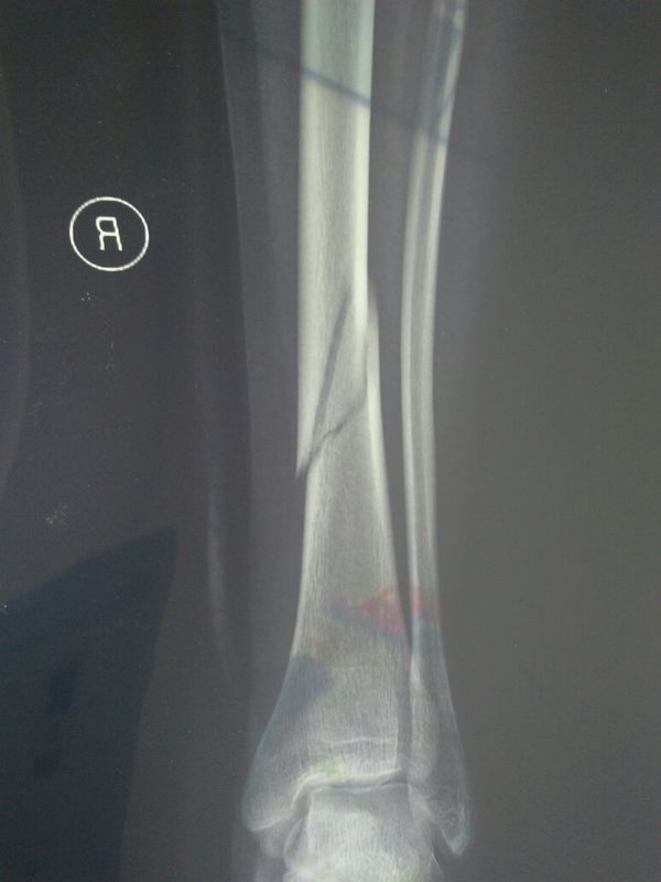 35岁,女,右小腿胫骨下段三分之一处骨折石膏托