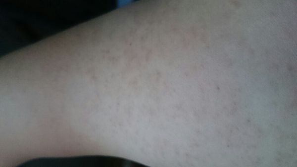 手臂上长了密密麻麻的小点点,有些一挤的话有