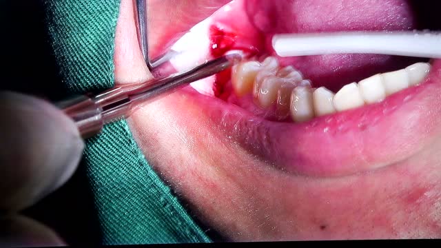 超声骨刀机拔牙