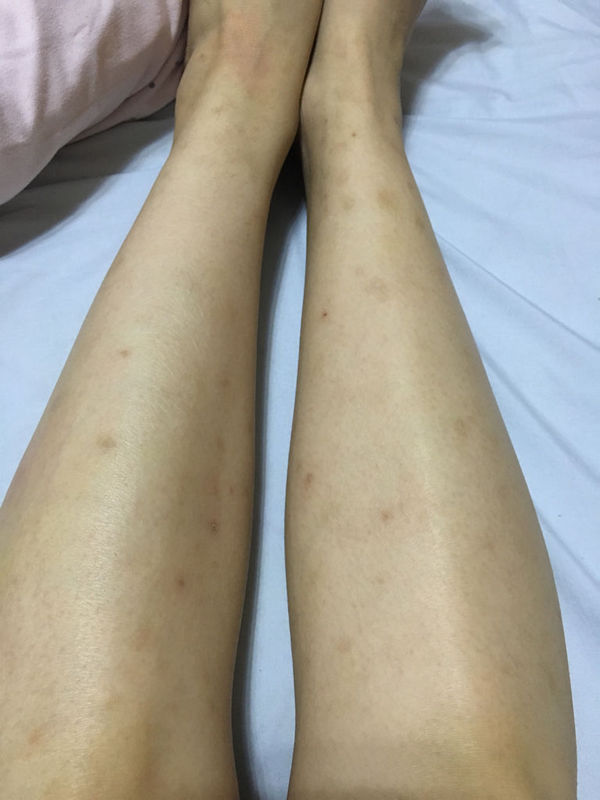 被蚊子咬了,抓破后会留下黑疤,从小就是这样的,用什么能去除?