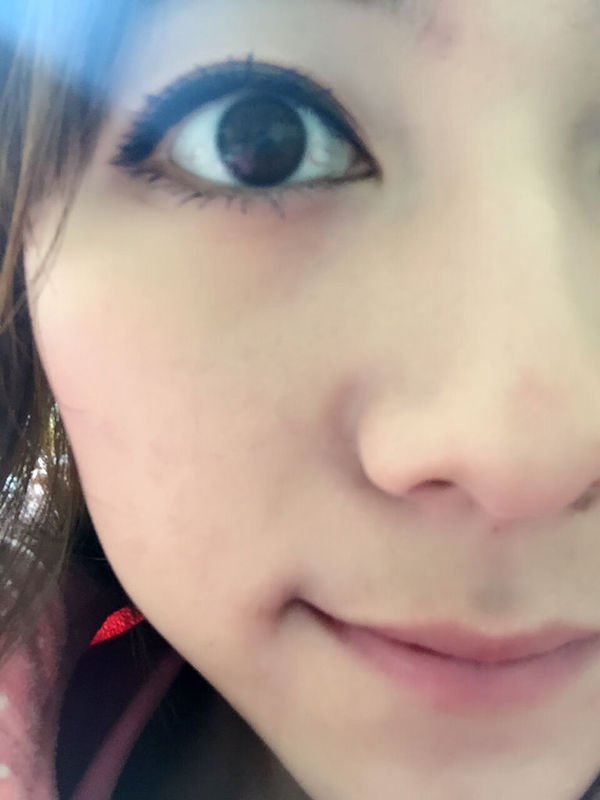 为什么眼白一直有这样的红血丝?跟戴隐形眼镜