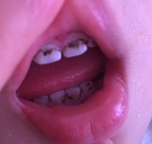 宝宝1岁4个月,发现乳牙前面的上下4颗门牙是黑黑的,不知道怎么会这样?