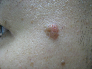 皮肤癌的早起图片?