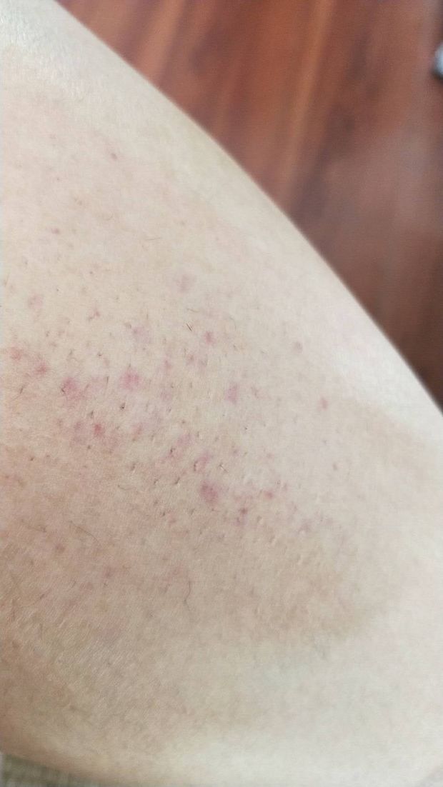 早上起来发现被蚊子咬了一个包 应该是被蚊子