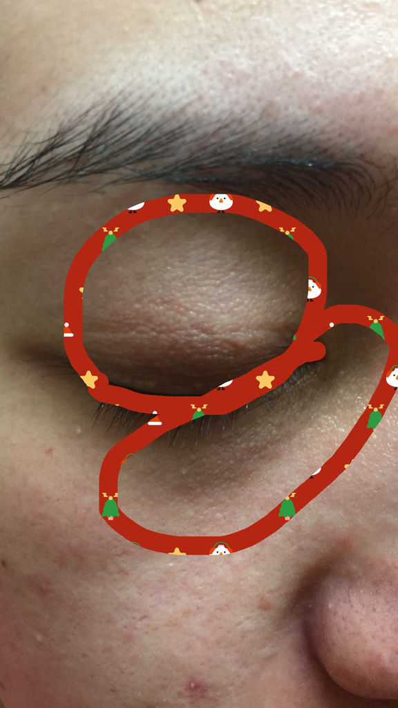 脂肪粒?汗管瘤?皮脂腺异位?还是栗丘疹?