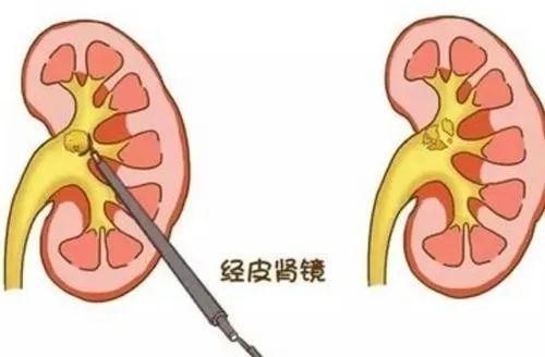 腎結石患者身體哪個部位疼