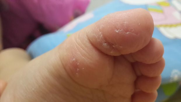 宝宝的脚大家帮忙看看是不是湿疹