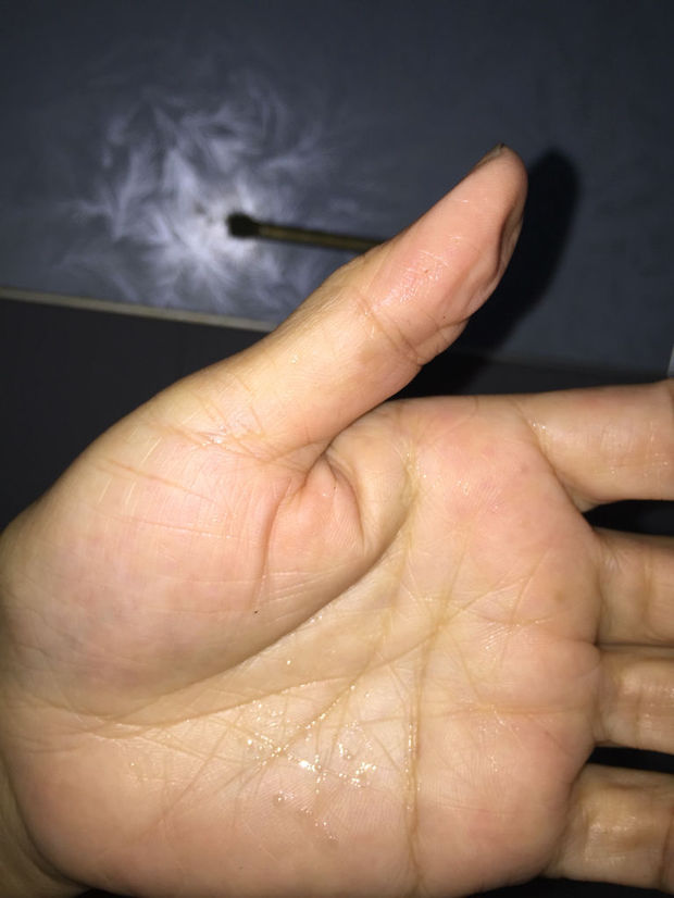 一对手掌大拇指下面连接部分涨疼,从中西医角度是什么原因呢?