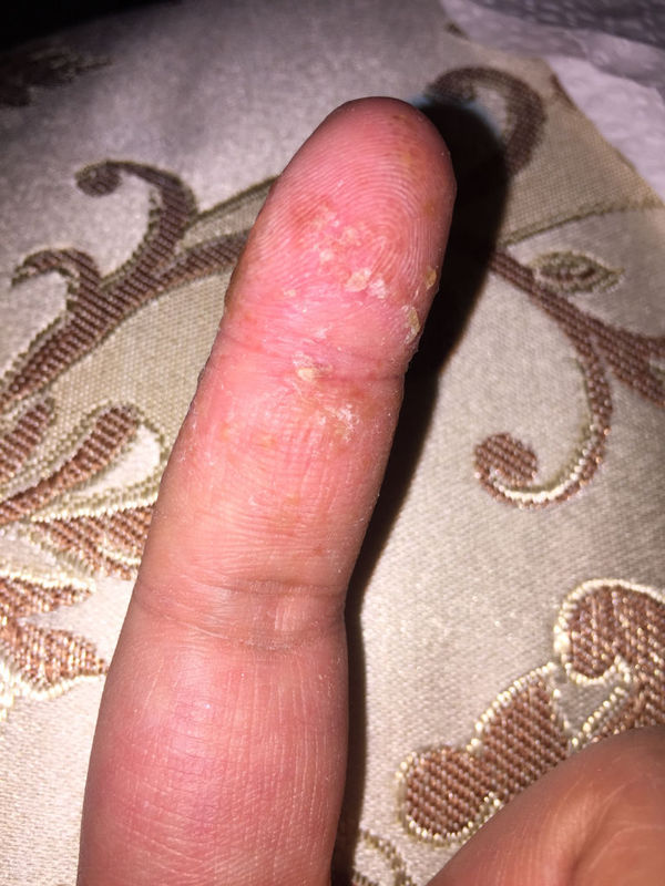 手上起小泡不疼不痒,几乎没有感觉,泡破了以后