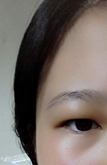 眼睛浮肿,并且眼皮松弛怎么办?