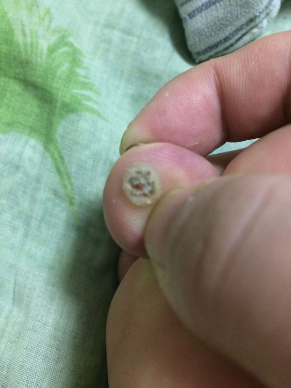 疣子如何治疗,冷冻啥的就算了