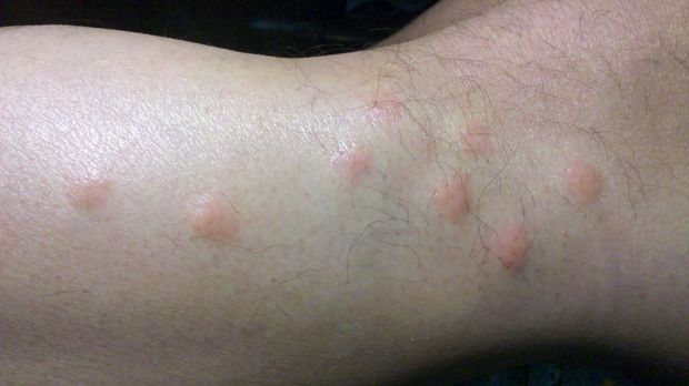 身上长好多红色的包,特别痒