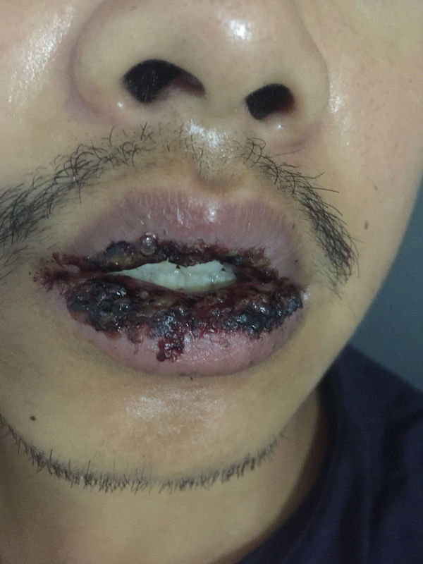 前两天嘴巴抿了一下,嘴唇就麻掉了,没有知觉起水泡,然后自己就把嘴唇