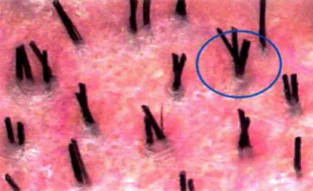 植发成活率大概是多少