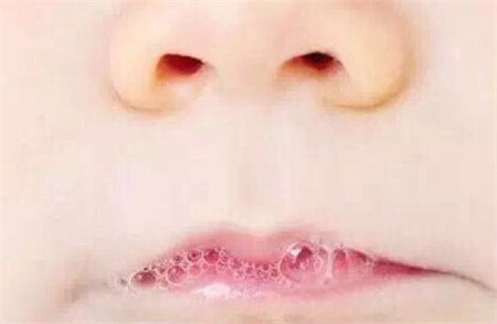 新生儿吐泡泡一定是肺炎吗