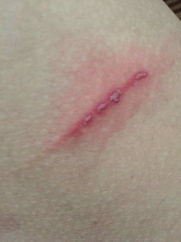 大腿内侧长了类似擦伤的东西,但我并没有受伤的啊,昨天才发现,摸上去