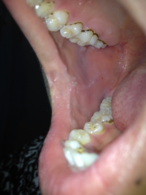 口腔里有这种白点点 沿着上下嘴唇各一串 左边少一点 一扣可以扣掉皮