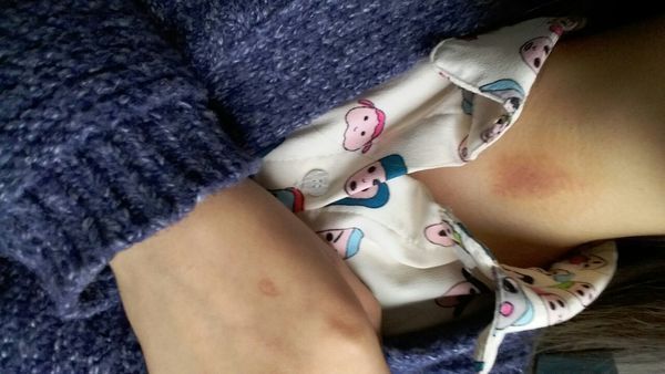 这样的吻痕几天才能消除